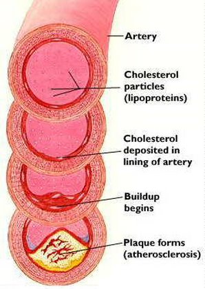 clogged arteries